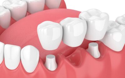 Dental Crown Vs Dental Bridge – Which One Is Better?